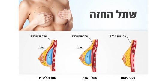 שתל החזה אילוסטרציה