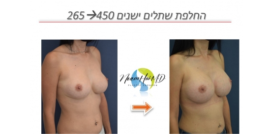 החלפת-שתלים-ישנים-265-ל-450