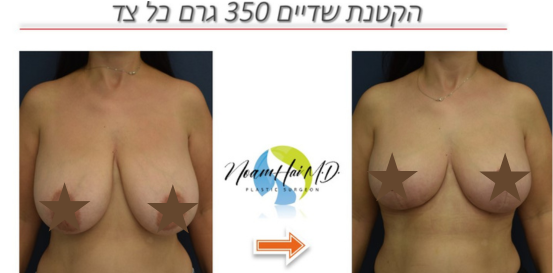 הקטנת-חזה-פרונט-350-גרם-כל-צד