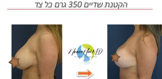 הקטנת-שדיים-370-גרם-כל-צד לפני אחרי