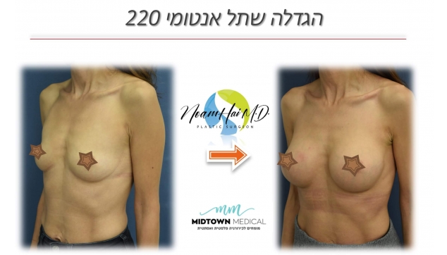 הגדלה שתל אנטומי 220