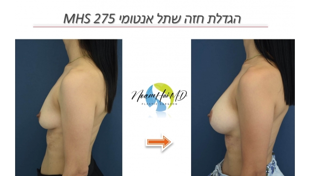 הגדלה אנטומית 275 MHS