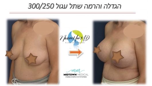 הגדלה והרמה שתל עגול 250-300