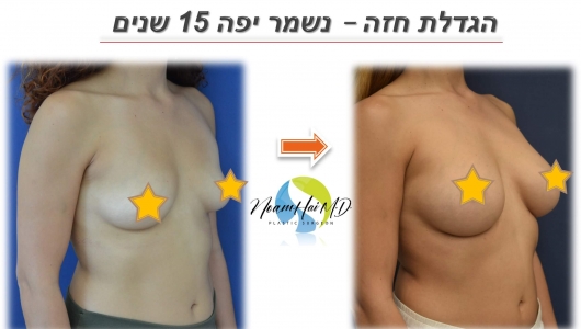 הגדלת חזה 10 לפני אחרי