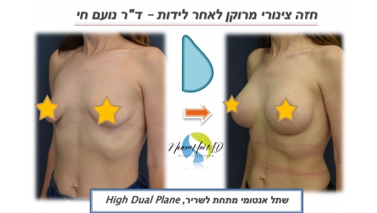 הגדלת חזה 30 לפני אחרי