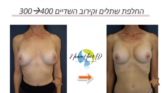 החלפת-שתלים-וקירוב-השדיים