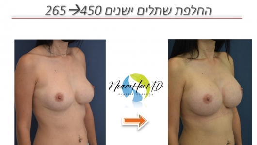 החלפת-שתלים-ישנים-265-ל-450