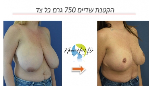 הקטנת שדיים 750 גרם כל צד