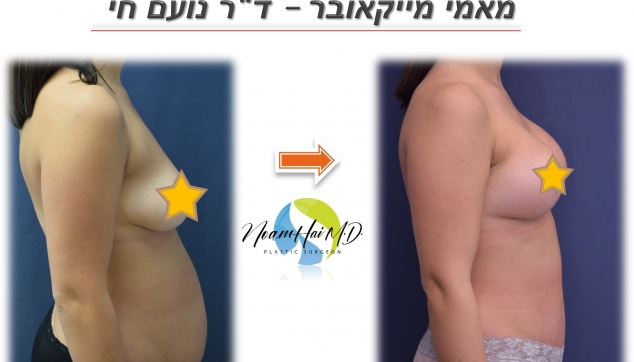 ניתוח מאמי מייקאובר משולב