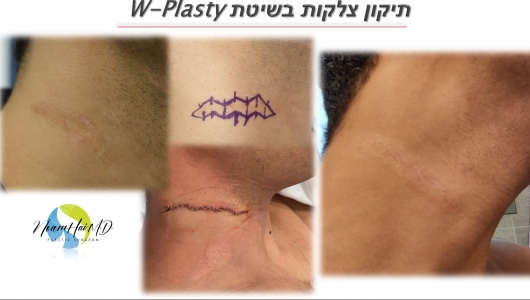 תיקון צלקות בשיטת w-plasty